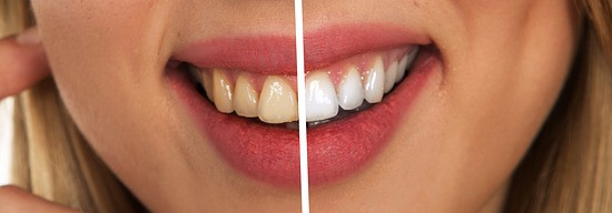 Dientes blancos Galapagar Colmenarejo